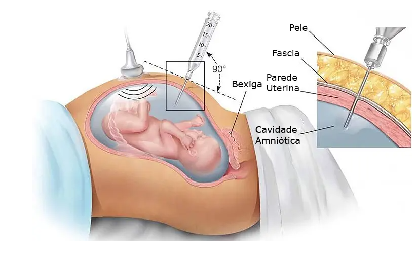 Transfus O Sangu Nea Fetali Medicina Fetal E Ultrassonografia